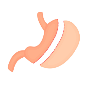 Gastric Sleeve Graphic