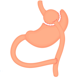 Gastric Bypass Graphic